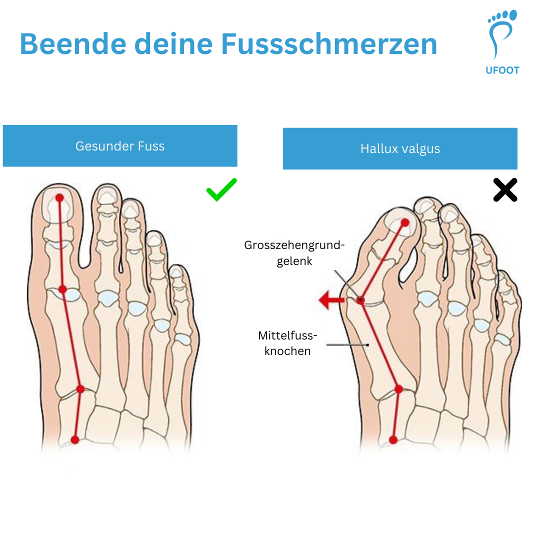 Zehentrenner Hallux Valgus  ufoot   