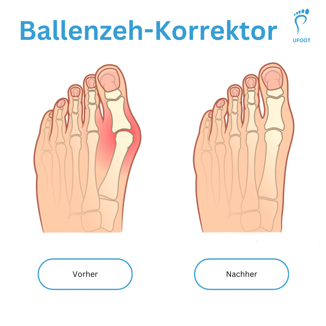 Zehenspreizer Hallux Valgus Ballenpflege ufoot   